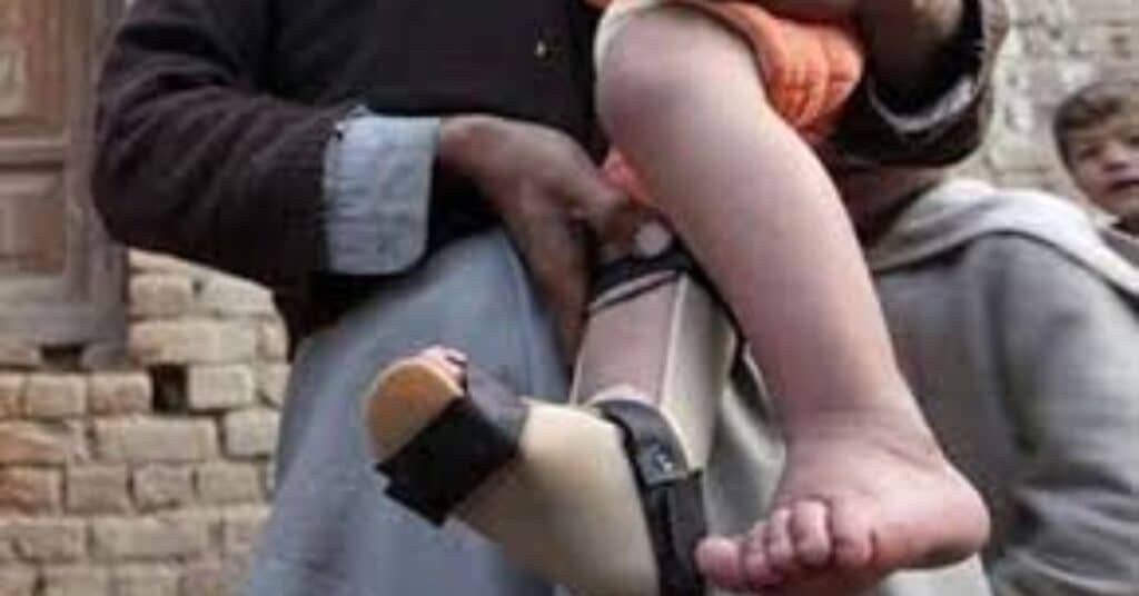 polio