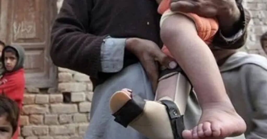 polio