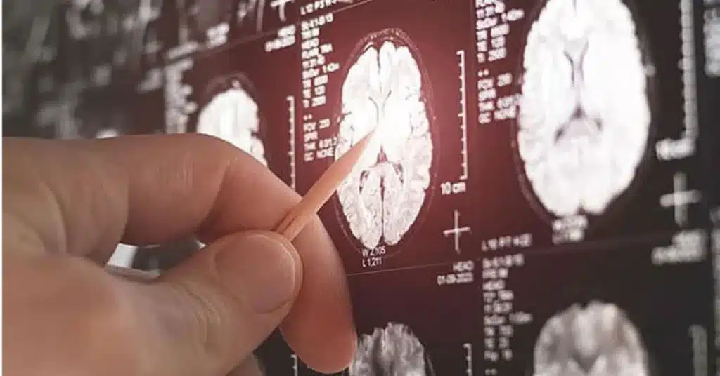 brain tumor