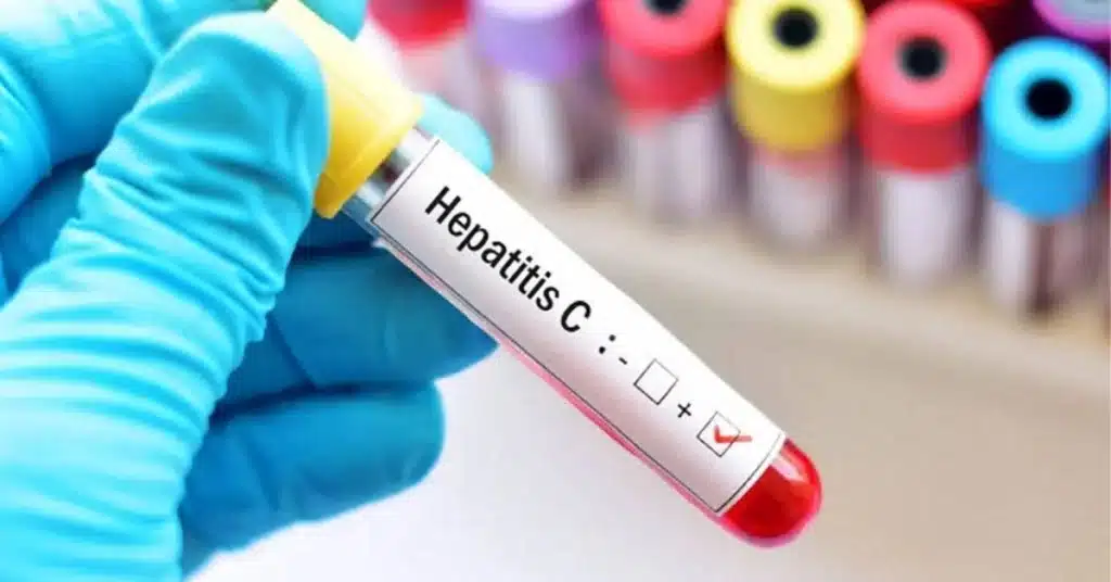 Free hepatitis treatment facility launched in Azad Kashmir